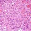 5A6 Papillary Tumor Pineal Region (Case 5) H&E 5.jpg