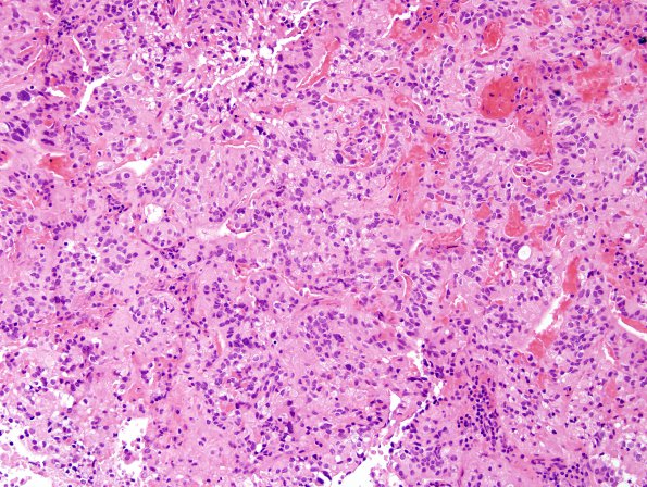 5A6 Papillary Tumor Pineal Region (Case 5) H&E 5.jpg