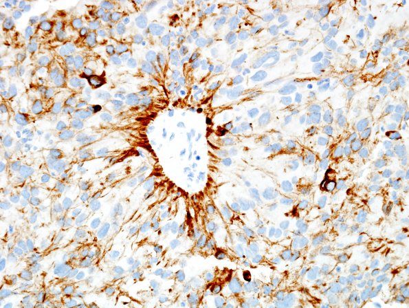 5B2 Papillary Tumor Pineal Region (Case 5) CAM52 5.jpg