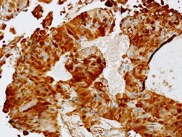 5C Papillary Tumor Pineal Region (Case 5) S100 3.jpg