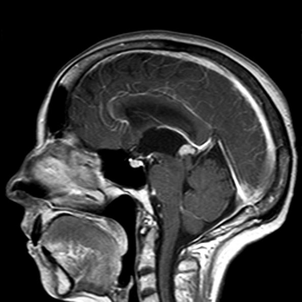 6A1 Papillary Tumor of the Pineal Region (PTPR) (Case 6) MRI 1 copy - Copy