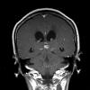 6A2 Papillary Tumor of the Pineal Region (PTPR) (Case 6) MRI 2 copy - Copy