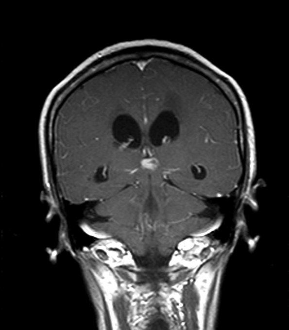 6A2 Papillary Tumor of the Pineal Region (PTPR) (Case 6) MRI 2 copy - Copy