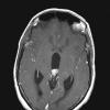 6A3 Papillary Tumor of the Pineal Region (PTPR) (Case 6) MRI 3 copy - Copy