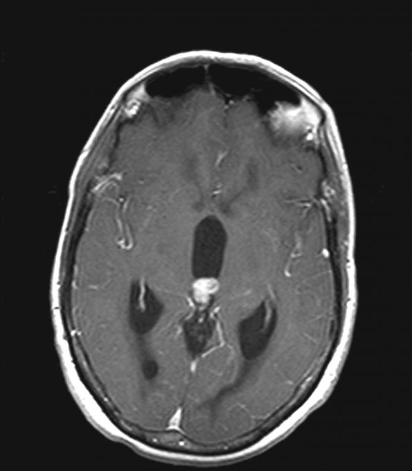 6A3 Papillary Tumor of the Pineal Region (PTPR) (Case 6) MRI 3 copy - Copy