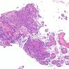 6B1 Papillary Tumor Pineal Region (Case 6) H&E 1