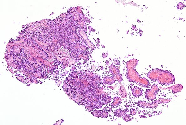 6B1 Papillary Tumor Pineal Region (Case 6) H&E 1