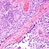 6B3 Papillary Tumor Pineal Region (Case 6) H&E 6