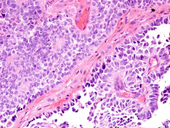 6B3 Papillary Tumor Pineal Region (Case 6) H&E 6