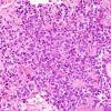 6B4 Papillary Tumor Pineal Region (Case 6) H&E 7