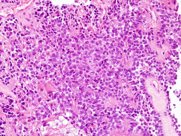 6B4 Papillary Tumor Pineal Region (Case 6) H&E 7