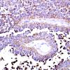 6D Papillary Tumor Pineal Region (Case 6) AE1-AE3 2