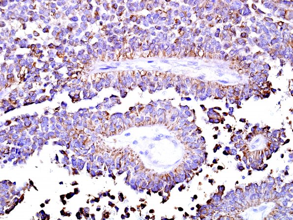 6D Papillary Tumor Pineal Region (Case 6) AE1-AE3 2