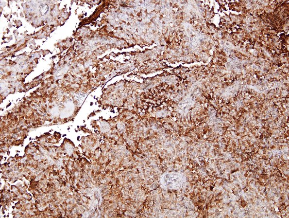 6E Papillary Tumor Pineal Region (Case 6) S100 1