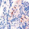 6F2 Papillary Tumor of the Pineal Region (PTPR) (Case 6) EMA 3.jpg