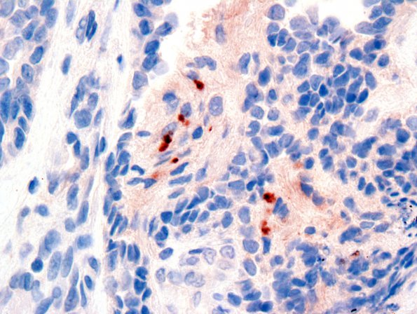 6F2 Papillary Tumor of the Pineal Region (PTPR) (Case 6) EMA 3.jpg