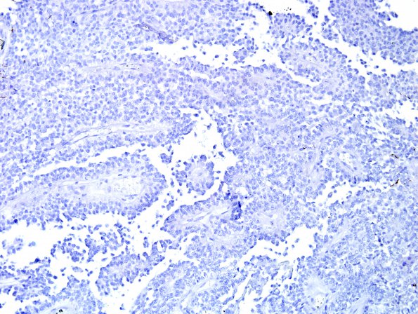 6G Papillary Tumor Pineal Region (Case 6) NF 2