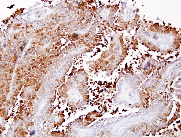 6I Papillary Tumor Pineal Region (Case 6) NSE 1 (2).jpg