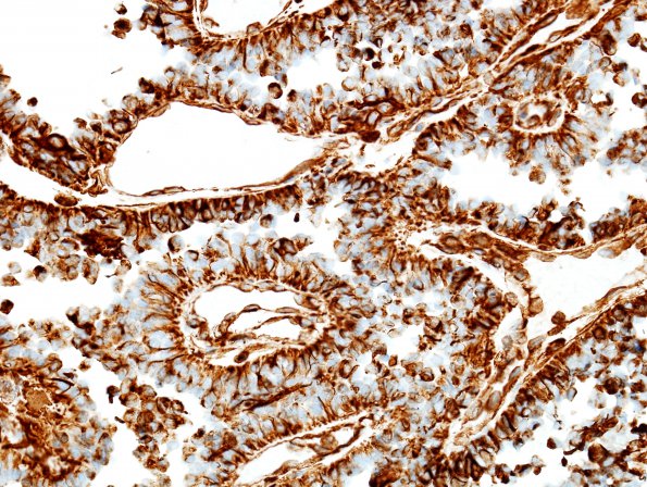 6J Papillary Tumor Pineal Region (Case 6) VIM 1