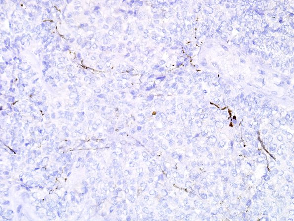 6K Papillary Tumor Pineal Region (Case 6) SYN 1