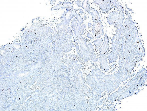 6L Papillary Tumor Pineal Region (Case 6) Ki67 1