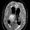 7A1 Papillary Tumor Pineal Region (Case 7) 3D FLAIR axial - Copy