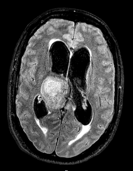 7A1 Papillary Tumor Pineal Region (Case 7) 3D FLAIR axial - Copy