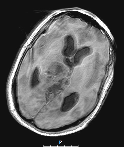 7A2 Papillary Tumor Pineal Region (PTPR, Case 7) T1noC axial 2 A - Copy