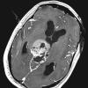 7A3 Papillary Tumor Pineal Region (PTPR, Case 7) T1W axial A - Copy