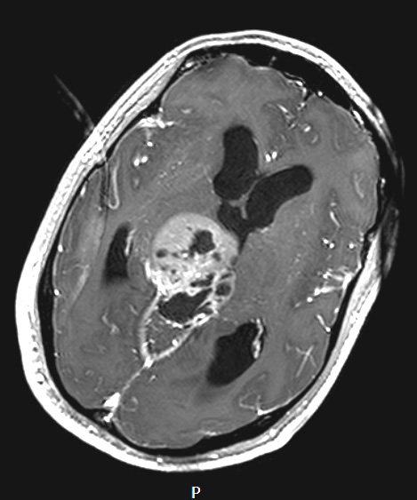 7A3 Papillary Tumor Pineal Region (PTPR, Case 7) T1W axial A - Copy