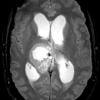 7A4 Papillary Tumor Pineal Region (PTPR, Case 7) T2noC axial A - Copy