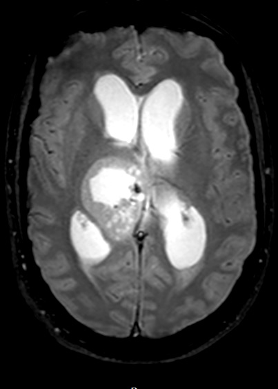 7A4 Papillary Tumor Pineal Region (PTPR, Case 7) T2noC axial A - Copy