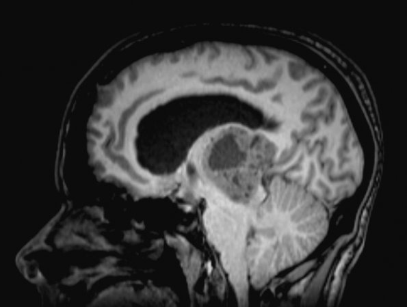 7A5 Papillary Tumor Pineal Region (PTPR, Case 7) T1noC sag A - Copy