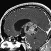 7A6 Papillary Tumor Pineal Region (PTPR, Case 7) T1W sag - Copy