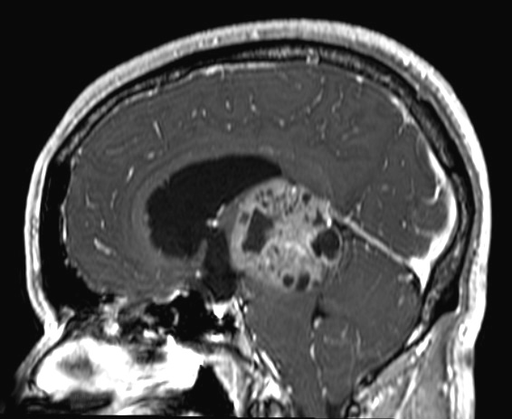 7A6 Papillary Tumor Pineal Region (PTPR, Case 7) T1W sag - Copy