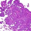 7B1 Papillary Tumor Pineal Region (PTPR, Case 7) H&E 3.jpg