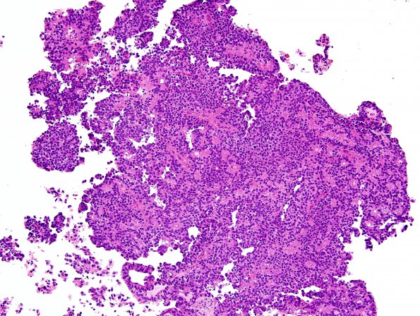 7B1 Papillary Tumor Pineal Region (PTPR, Case 7) H&E 3.jpg