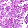 7B2 Papillary Tumor Pineal Region (PTPR, Case 7) H&E 6.jpg