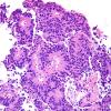 7B3 Papillary Tumor Pineal Region (PTPR, Case 7) H&E 3.jpg