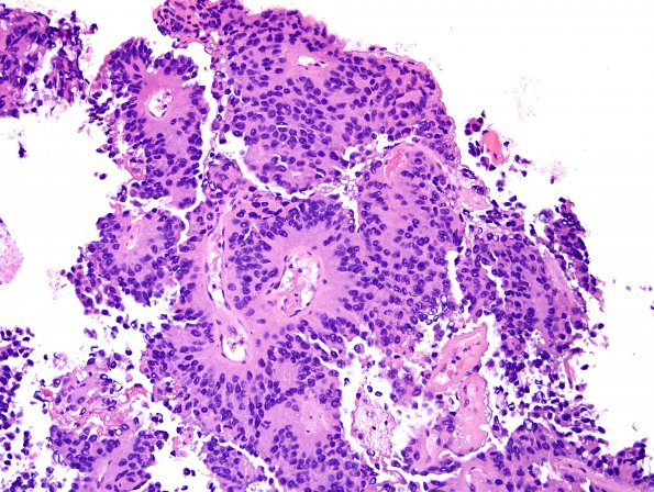 7B3 Papillary Tumor Pineal Region (PTPR, Case 7) H&E 3.jpg