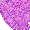 7B4 Papillary Tumor Pineal Region (PTPR, Case 7) H&E 7.jpg