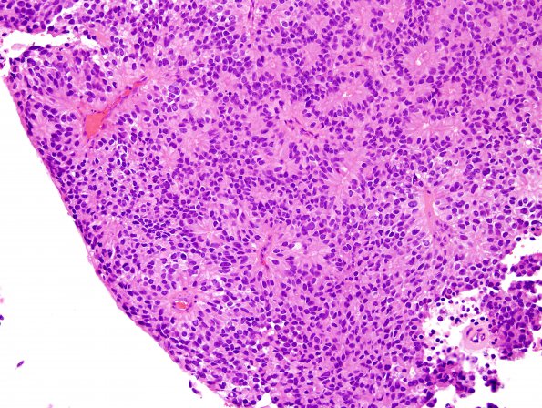 7B4 Papillary Tumor Pineal Region (PTPR, Case 7) H&E 7.jpg