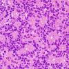 7B5 Papillary Tumor Pineal Region (PTPR, Case 7) H&E 5.jpg