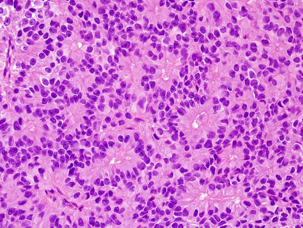 7B5 Papillary Tumor Pineal Region (PTPR, Case 7) H&E 5.jpg