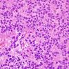 7B6 Papillary Tumor Pineal Region (PTPR, Case 7) H&E 6.jpg