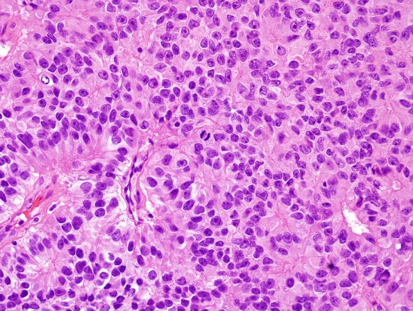 7B6 Papillary Tumor Pineal Region (PTPR, Case 7) H&E 6.jpg