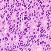 7B7 Papillary Tumor Pineal Region (PTPR, Case 7) inclusions H&E 2 copy.jpg