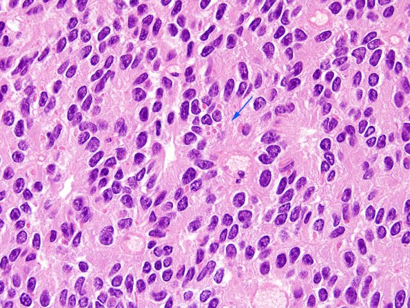 7B7 Papillary Tumor Pineal Region (PTPR, Case 7) inclusions H&E 2 copy.jpg