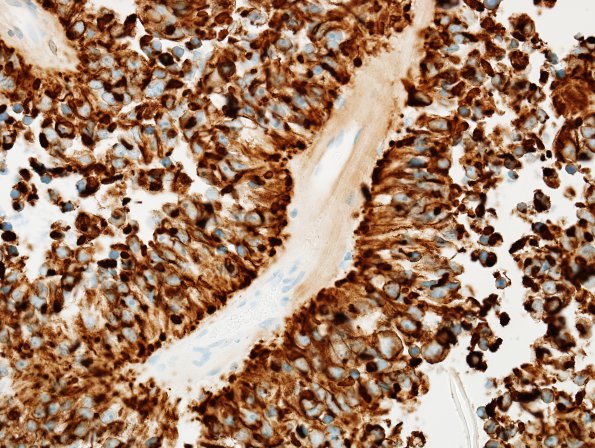 7C2 Papillary Tumor Pineal Region (PTPR, Case 7) CAM52 4.jpg