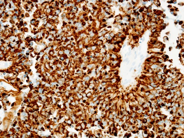 7C3 Papillary Tumor Pineal Region (Case 7) inclusions CAM52 3.jpg